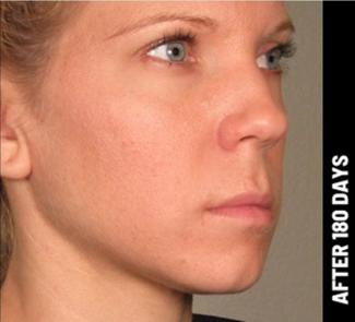 Ultherapy Before & After Patient #1549